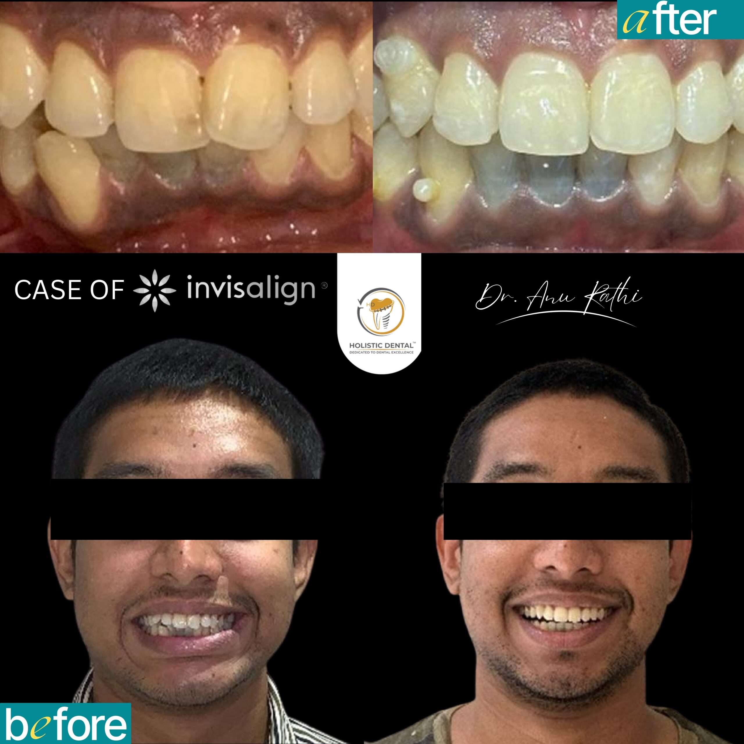 Before After Invisalign_page-0001