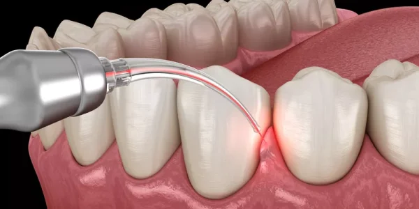 Gum-Disease-Laser-Treatment-Level-View-1-1-1-1-1-1.webp